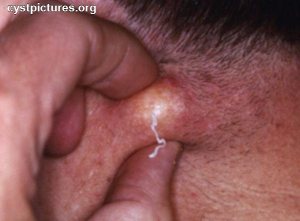 Majora cysts on labia Sebaceous cysts